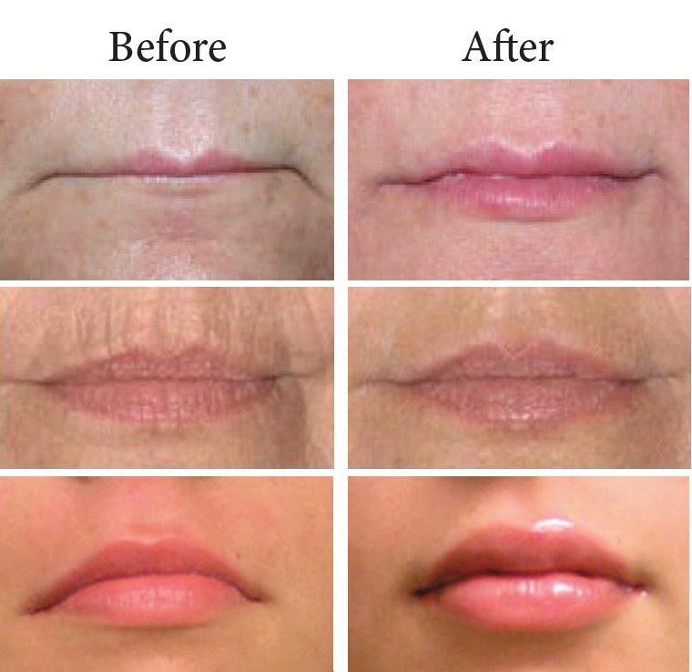 calgary lip filler injections