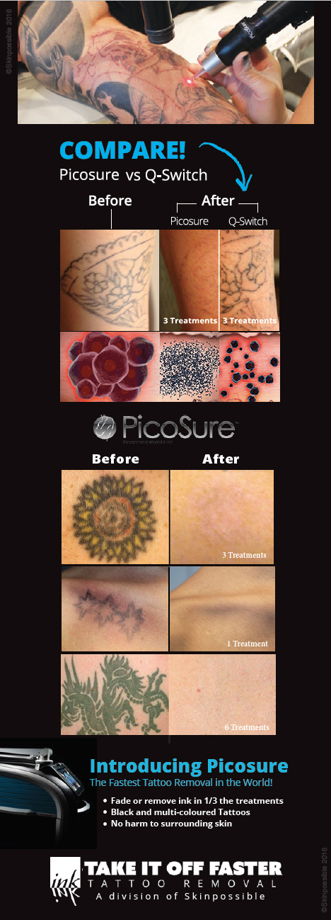 laser-tattoo-removal-calgary