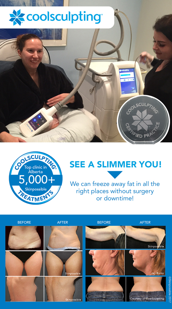 Coolsculpting-calgary