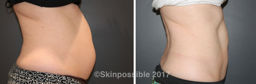 skinpossible-Coolsculpting-calgary2