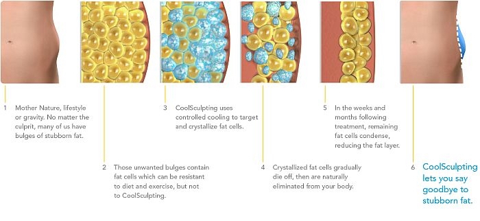 Coolsculpting-howdoesitwork