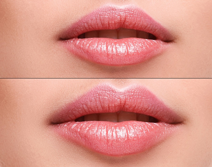 dermal-filler-for-lips-calgary