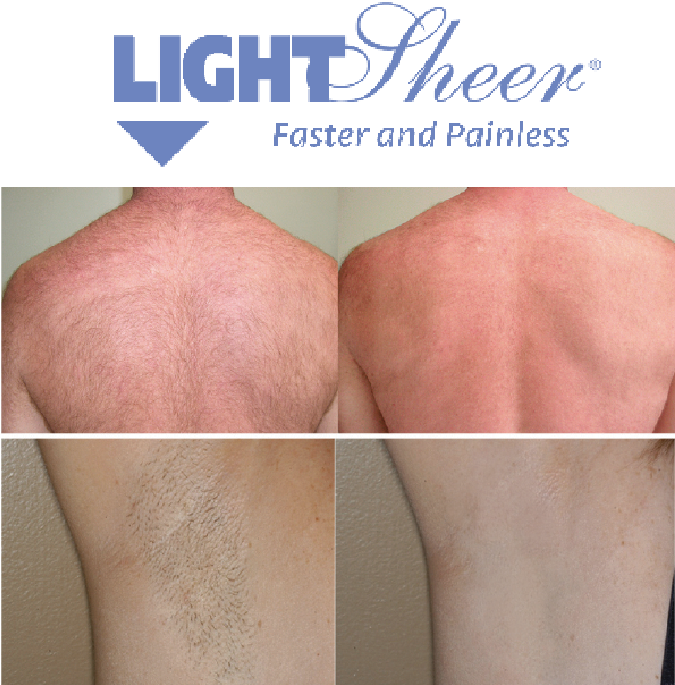 Laser Hair removal