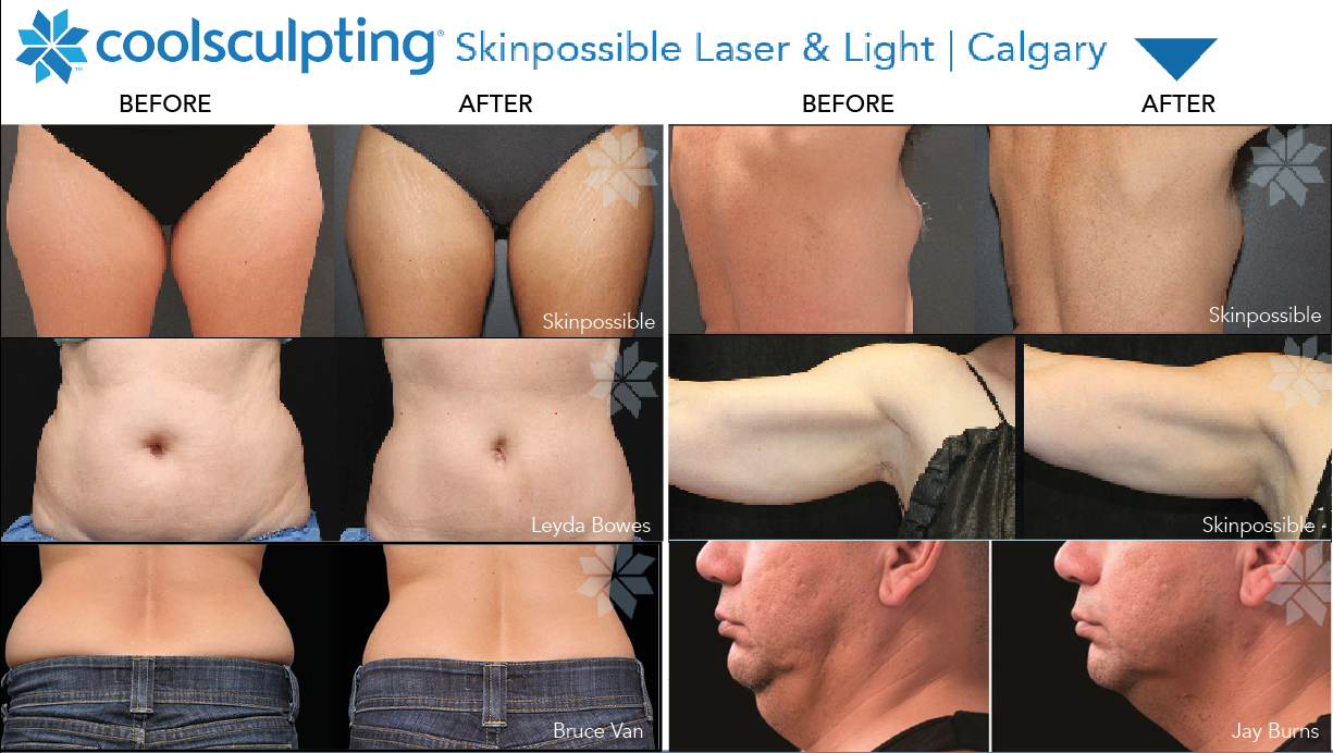 body-contouring-treatment-calgary