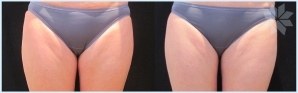 coolsculpting-innerthighs