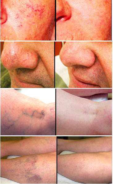 laser-vein-therapy-calgary